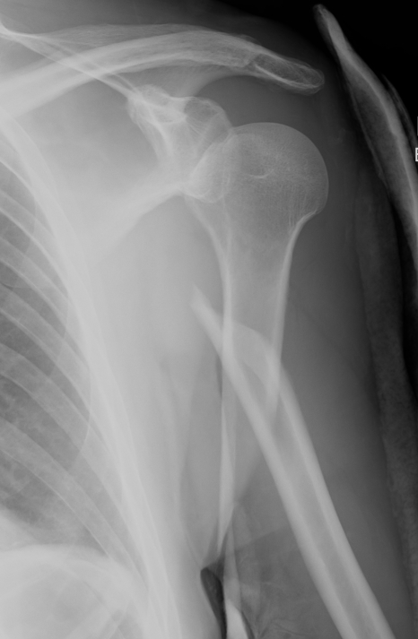 Displaced Humeral Fracture AP